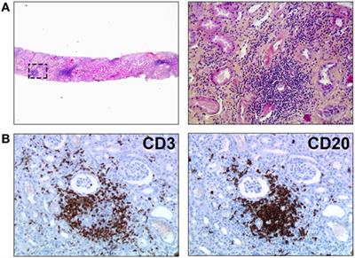 Lymphoid Neogenesis and Tertiary Lymphoid Organs in Transplanted Organs